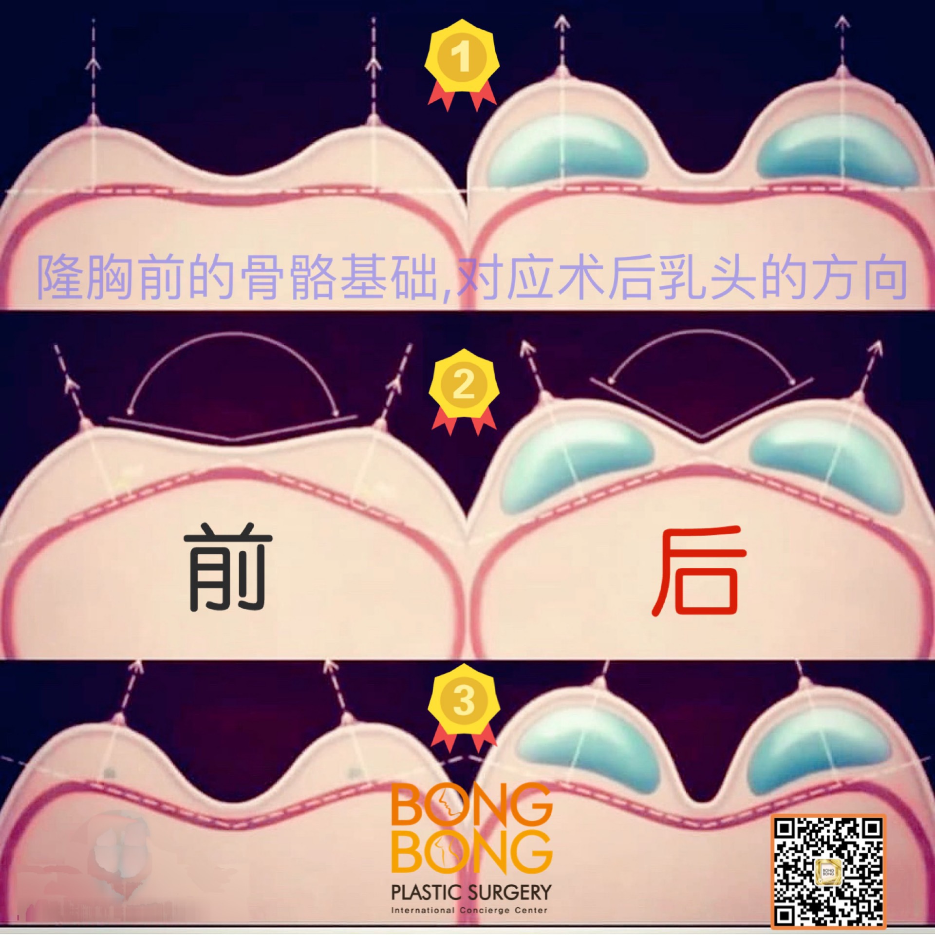 【棒棒无痛假体隆胸-科普】